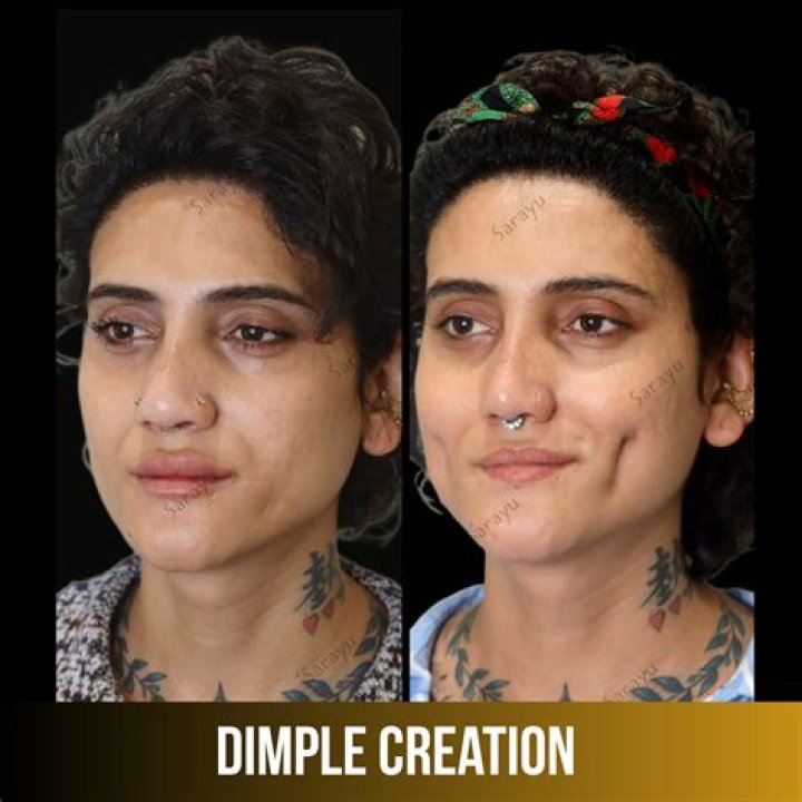 Can dimples be removed?