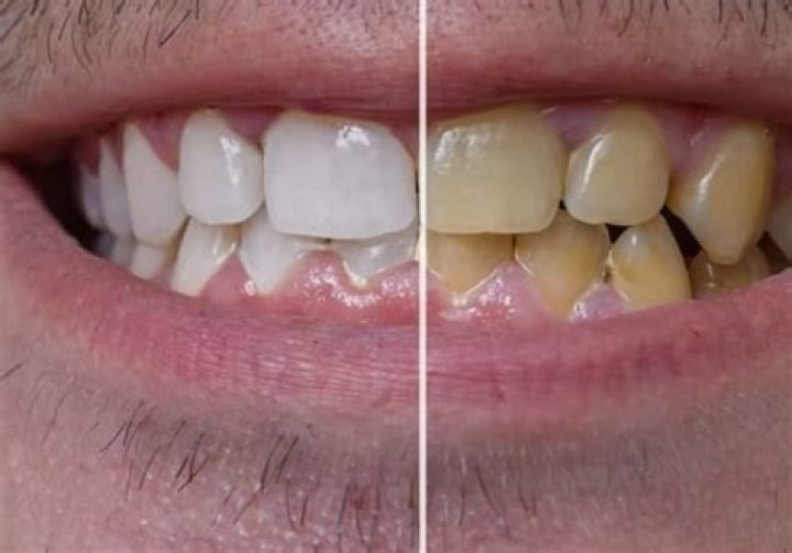 How do you remove yellow stains from veneers?