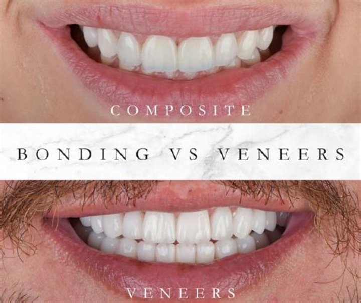 What toothpaste is good for veneers?