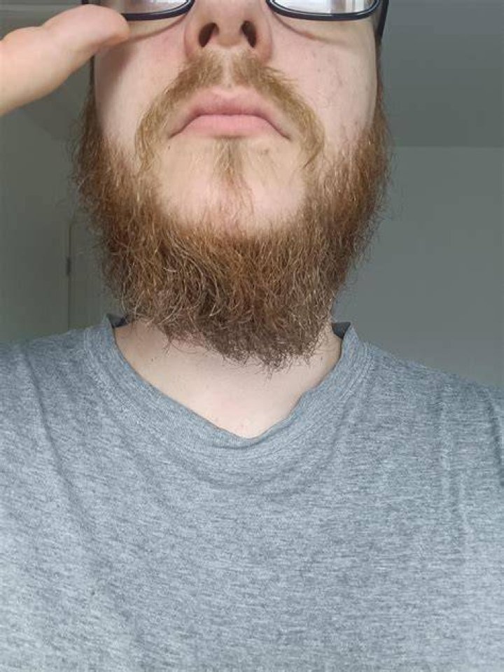 Why can't I grow hair under my lip?